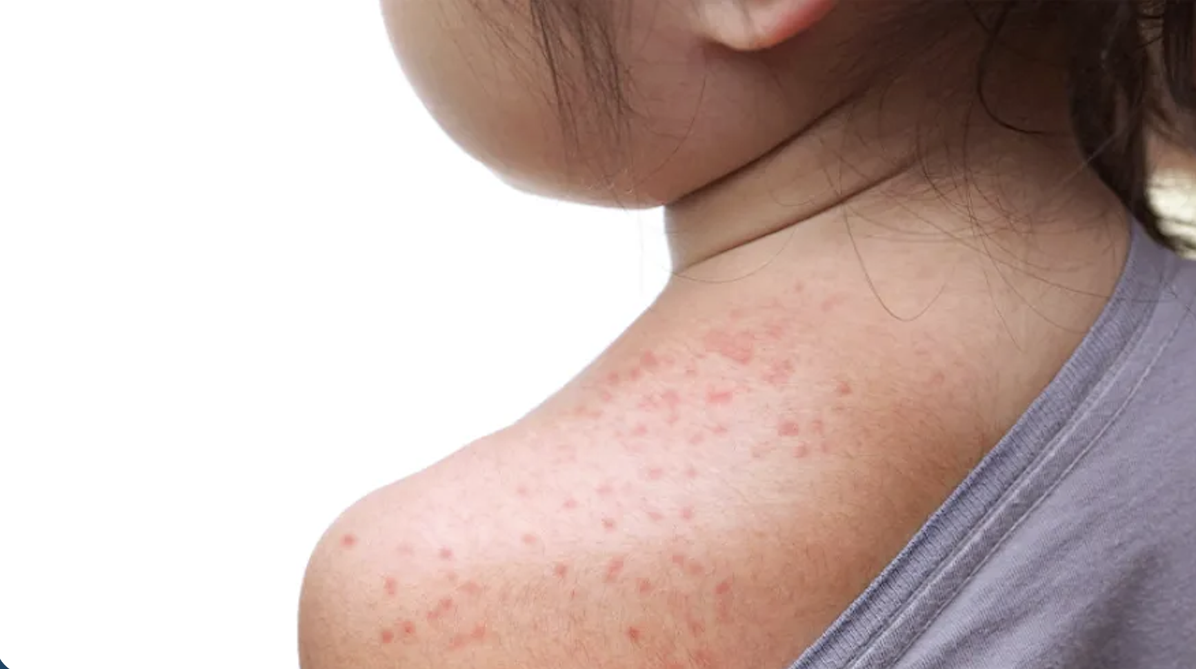 What you need to know about measles 
												post image