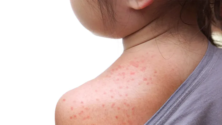What you need to know about measles 
												post image