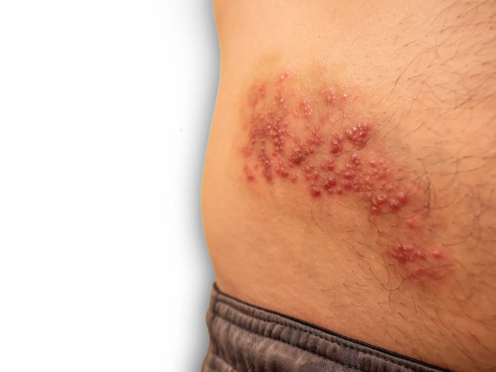 What you should know about shingles post image